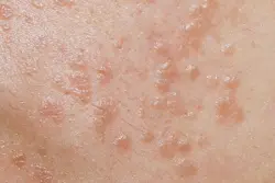 زگیل صورت